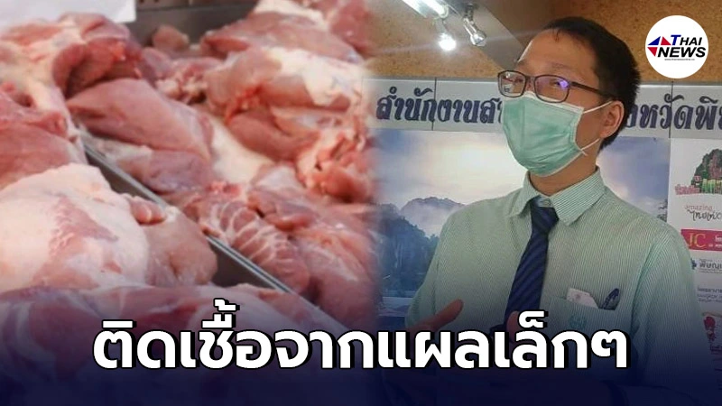 อาจารย์ ม.ดัง มือเป็นแผล ซื้อหมูจากห้าง หั่นทำหมูกระทะ สุดท้ายเป็นโรคหูดับ