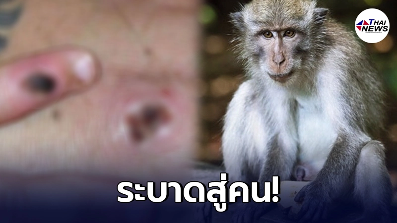 พบ "ฝีดาษลิง" แพร่สู่คน 2 ราย ในสหราชอาณาจักร ทางตอนเหนือของประเทศเวลส์