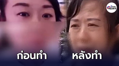 สาวจีนศัลยกรรม กรีดตา 2 ชั้น หวังสวยสดใส หน้าเปลี่ยนไปมาก จนผัวขอหย่า
