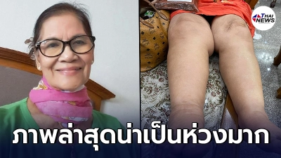 เผยภาพ ป้าแมว ดาวพระศุกร์ ล่าสุด เท้าบวมใหญ่ แฟนๆต่างแห่ห่วงใย เผยภาพ ป้าแมว ดาวพระศุกร์ ล่าสุด เท้าบวมใหญ่ แฟนๆต่างแห่ห่วงใย