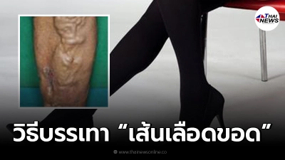 กรมการแพทย์ แนะวิธีการใส่ถุงน่อง เพื่อการรักษาเส้นเลือดขอด