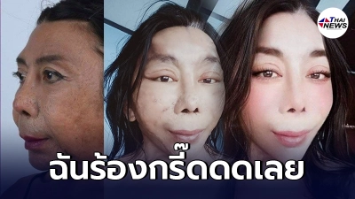 "สิตางศุ์ บัวทอง" โชว์ภาพก่อน-หลัง ทำศัลยกรรม