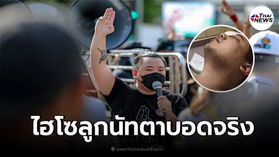 "ไฮโซลูกนัท"ตาขวาบอด จะไม่สามารถมองเห็นได้อีก