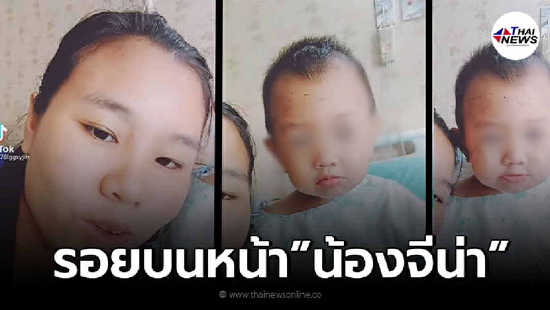 ชาวเน็ตแห่สงสาร "รอยบนหน้า"น้องจีน่า หลัง แม่ออกมาเผยคลิปเล่าอาการล่าสุด