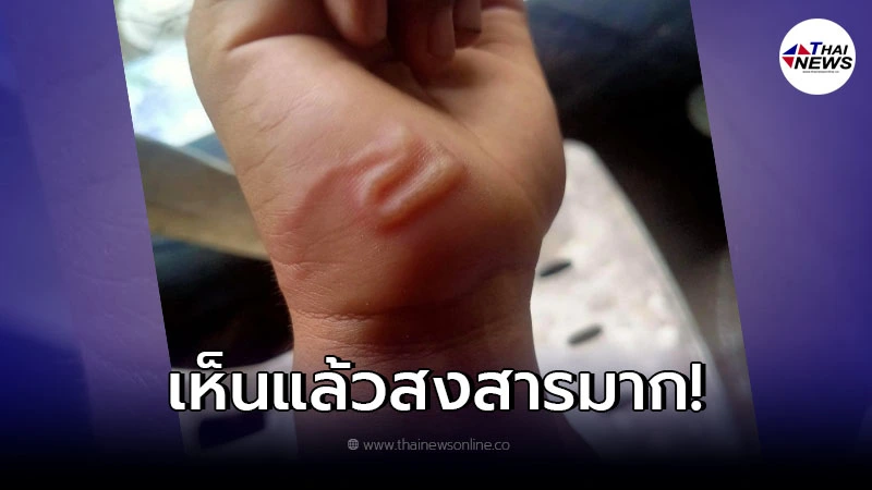 ระวังให้ดี แม่ตกใจ เห็นตัวอะไรขยับอยู่มือลูกชาย ระวังให้ดี แม่ตกใจ เห็นตัวอะไรขยับอยู่มือลูกชาย