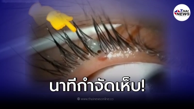 คลินิกจักษุแพทย์ เผยคลิปนาทีเห็บกัดเปลือกตา เตือนไม่ควรดึงออกเอง คลินิกจักษุแพทย์ เผยคลิปนาทีเห็บกัดเปลือกตา เตือนไม่ควรดึงออกเอง