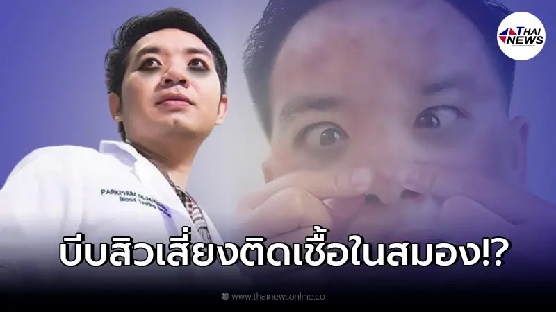 หมอแล็บแพนด้า ช่วยตอบข้อสงสัย การบีบสิวปลายจมูก เสี่ยงติดเชื้อในสมอง หมอแล็บแพนด้า ช่วยตอบข้อสงสัย การบีบสิวปลายจมูก เสี่ยงติดเชื้อในสมอง