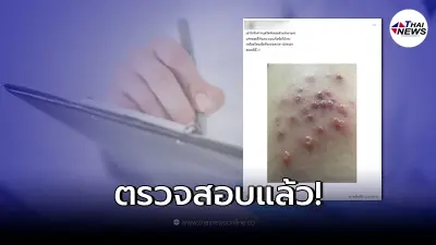 กรมการแพทย์ เผยแล้ว  โรคงูสวัด หากขึ้นวนรอบตัวจะทำให้เสียชีวิต จริงหรือไม่