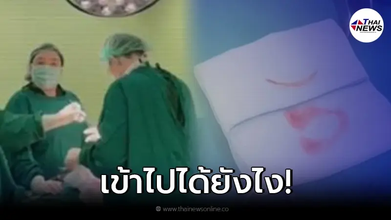 หนุ่มกินปลานิล จู่ๆ ปวดท้องหนัก ตัดสินใจไปหาหมอ สุดท้ายต้องผ่าตัดด่วน