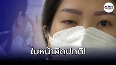 สาวร้องสบส. ฉีดโบท็อกซ์คลินิก "พิมรี่พาย" ผ่านไป 1 วัน หนังตาตก ใบหน้าผิดปกติ สาวร้องสบส. ฉีดโบท็อกซ์คลินิก "พิมรี่พาย" ผ่านไป 1 วัน หนังตาตก ใบหน้าผิดปกติ