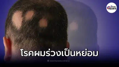 ทำความรู้จัก "โรคผมร่วงเป็นหย่อม" เกิดจากอะไร