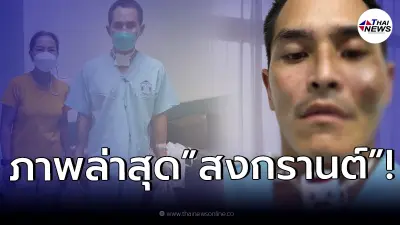"สงกรานต์" เผยภาพใบหน้าหลังเข้ารักษาตัว ลั่น กว่าเฟซไอดีจะจำหน้าได้ "สงกรานต์" เผยภาพใบหน้าหลังเข้ารักษาตัว ลั่น กว่าเฟซไอดีจะจำหน้าได้