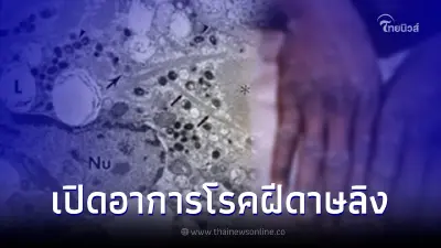 เปิดอาการ "โรคฝีดาษลิง" ไขข้อสงสัยทำไม กลุ่มเสี่ยงคือคนเกิดหลัง พ.ศ. 2523 เปิดอาการ "โรคฝีดาษลิง" ไขข้อสงสัยทำไม กลุ่มเสี่ยงคือคนเกิดหลัง พ.ศ. 2523
