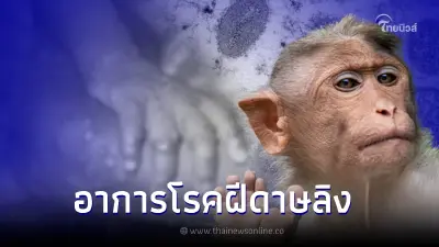 อาการ ผู้ป่วยแบบไหนเข้าข่าย "โรคฝีดาษลิง" มีอาการตามนี้รีบพบแพทย์ด่วน อาการ ผู้ป่วยแบบไหนเข้าข่าย "โรคฝีดาษลิง" มีอาการตามนี้รีบพบแพทย์ด่วน