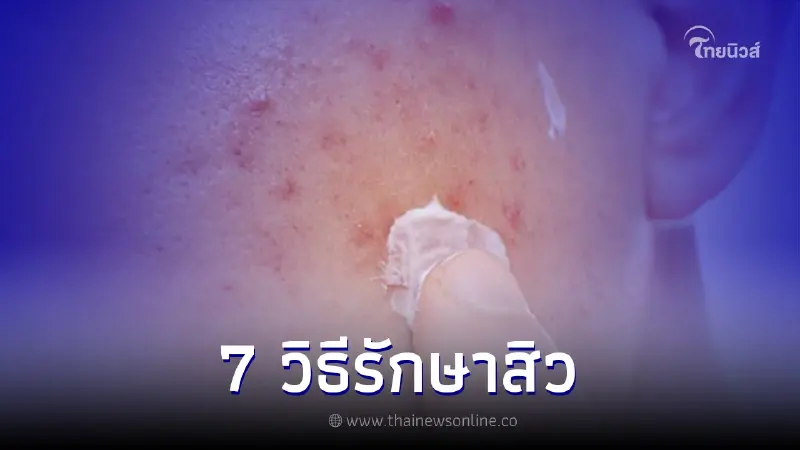7 วิธีรักษาสิวผู้ชาย แบบตรงจุด เพื่อหน้าหล่อใสไร้สิว