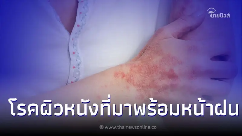 6 โรคผิวหนังยอดฮิต!ที่มาพร้อมกับหน้าฝน 6 โรคผิวหนังยอดฮิต!ที่มาพร้อมกับหน้าฝน