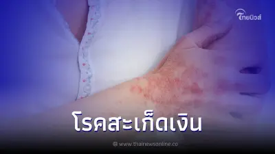 "โรคสะเก็ดเงิน" โรคผิวหนังที่รักษาไม่หายขาด