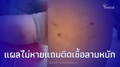 หนุ่มเตือนภัย แม่โดนแมวกัด ผ่านไป 8 วัน แผลช้ำเขียว เกิดการติดเชื้อ