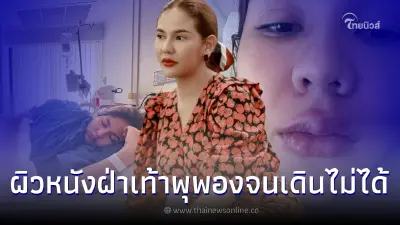 หมิว สิริลภัส อาการป่วยกำเริบ ผื่นขึ้นรุนแรง ต้องแอดมิทโรงพยาบาล