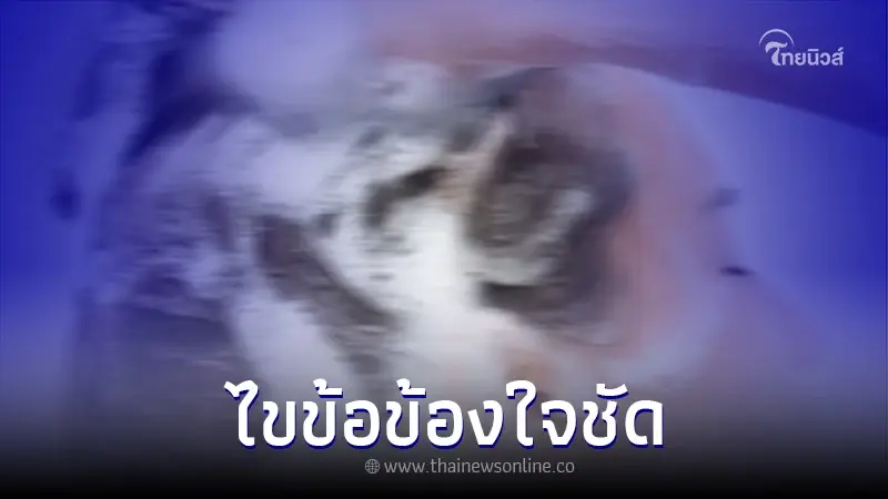 สระผมก่อนอาบน้ำ อาจทำให้เส้นเลือดแตกได้จริงหรือ สถาบันประสาทฯ ชี้แจงแล้ว