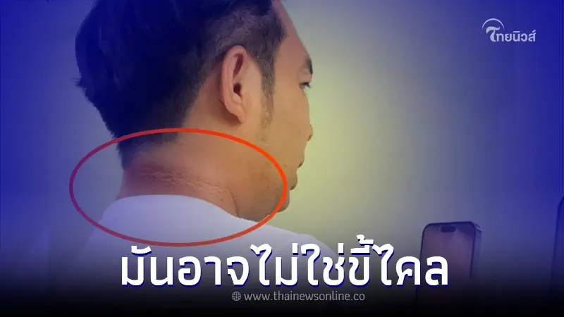 "หมอแล็บแพนด้า" เตือน รอยดำหลังคอ อาจไม่ใช่ ขี้ไคล ใครมีควรพบแพท์ทันที "หมอแล็บแพนด้า" เตือน รอยดำหลังคอ อาจไม่ใช่ ขี้ไคล ใครมีควรพบแพท์ทันที