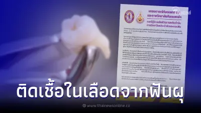ทันตแพทยสภา เร่งสอบผู้ป่วยถอนฟัน 12 ซี่ดับ พบติดเชื้อในกระแสเลือดผ่านฟันผุ ทันตแพทยสภา เร่งสอบผู้ป่วยถอนฟัน 12 ซี่ดับ พบติดเชื้อในกระแสเลือดผ่านฟันผุ