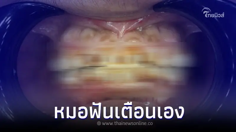 หมอฟัน เตือนเป็นอุทาหรณ์ เผยสภาพฟันคนไข้ หลังใช้กัญชาผ่านน้ำอัดลม มา 1 ปี หมอฟัน เตือนเป็นอุทาหรณ์ เผยสภาพฟันคนไข้ หลังใช้กัญชาผ่านน้ำอัดลม มา 1 ปี
