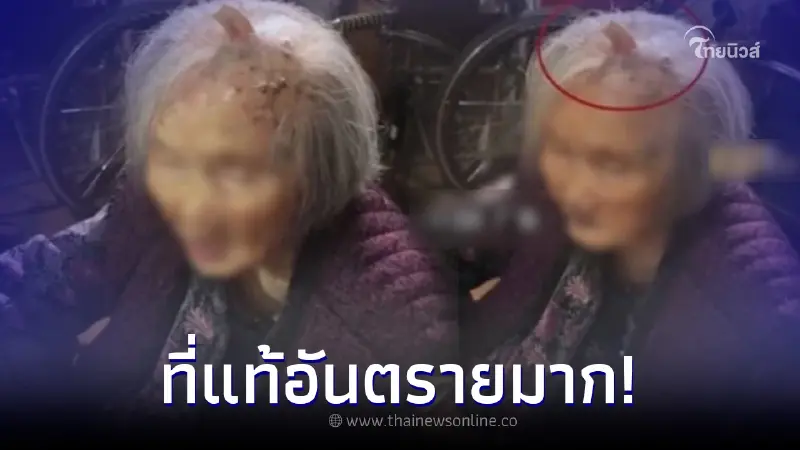 ฮือฮา หญิงชราวัย 107 มีเขางอกบนหัว นึกว่าความพิเศษ แต่แพทย์บอกอันตรายมาก
