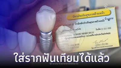 ใช้สิทธิ 'บัตรทอง' ใส่รากฟันเทียมฟรี! ได้แล้ว หมดเขตกันยายนปีหน้า