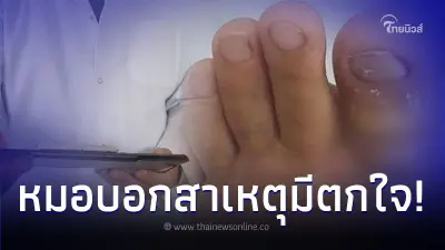 สาว 19 นึกรำคาญ ดึงขนคุดบนนิ้วหัวแม่เท้าออก สักพักไข้ขึ้นสูง จนต้องส่ง รพ.