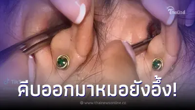หญิงปวดหูสุดทน รู้สึกข้างในมีอะไรแปลก ๆ ก่อนคีบออกมาหมอยังอึ้ง หญิงปวดหูสุดทน รู้สึกข้างในมีอะไรแปลก ๆ ก่อนคีบออกมาหมอยังอึ้ง