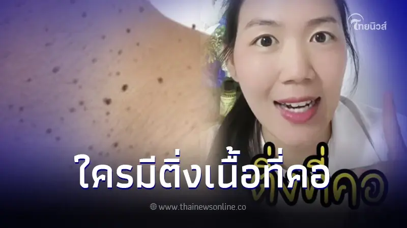 สังเกตตัวเอง แพทย์เตือน ติ่งเนื้อที่คอ สัญญาณบอกโรค พร้อมแนะวิธีรักษา สังเกตตัวเอง แพทย์เตือน ติ่งเนื้อที่คอ สัญญาณบอกโรค พร้อมแนะวิธีรักษา