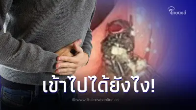 หมอตกใจทั้งคณะ ส่องกล้องตรวจลำไส้คนไข้เจอแมลงวันตัวเป็นๆ เกาะอยู่