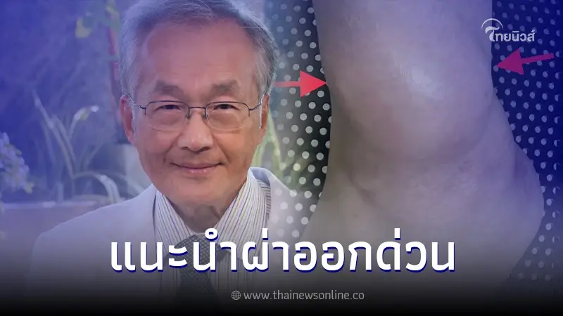 เช็กอาการด่วน! ใครมีก้อนนูนที่ขา โตขึ้นช้าๆ ปล่อยไว้เสี่ยงกลายเป็นมะเร็ง เช็กอาการด่วน! ใครมีก้อนนูนที่ขา โตขึ้นช้าๆ ปล่อยไว้เสี่ยงกลายเป็นมะเร็ง