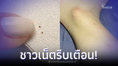 สาวโพสต์เตือน โดนแมลงปริศนากัด แผลอักเสบหนักทรมานไป 6 เดือน สาวโพสต์เตือน โดนแมลงปริศนากัด แผลอักเสบหนักทรมานไป 6 เดือน