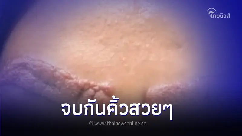 "หมออั้ม" แชร์อุทาหรณ์เตือน สาวๆ ที่อยากสักคิ้ว เลือกร้านให้ดีก่อนทำ "หมออั้ม" แชร์อุทาหรณ์เตือน สาวๆ ที่อยากสักคิ้ว เลือกร้านให้ดีก่อนทำ