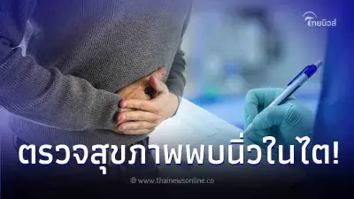 หนุ่มวัย 26 ตรวจสุขภาพ พบนิ่วในไตนับร้อยก้อน ตกใจพฤติกรรมที่ทำจนชิน