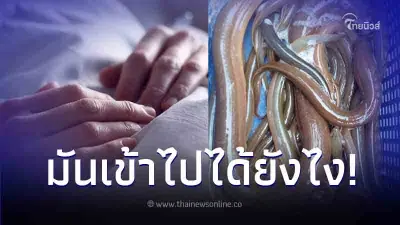 หมอผ่าเจอปลาไหลเป็นๆ ในท้องคนไข้ ยิ่งปวดหัวหนัก หลังถาม มันเข้าไปได้ยังไง