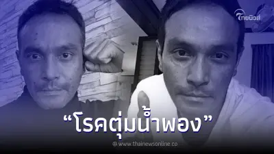 รู้จัก อาการเริ่มแรก "โรคตุ่มน้ำพอง" สาเหตุนำไปสู่การเสียชีวิต ของ เมฆ วินัย