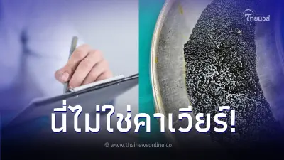 หมอยังตกใจ ผ่าตัด "นิ่ว" ออกจากร่างกายคนไข้ ได้หลายพันก้อน หมอยังตกใจ ผ่าตัด "นิ่ว" ออกจากร่างกายคนไข้ ได้หลายพันก้อน
