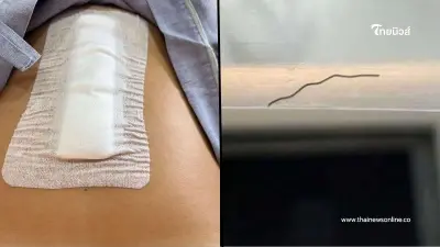 อุทาหรณ์ เศษฝอยขัดหม้อในอาหาร เผลอกินทำลำไส้ทะลุ เสี่ยงติดเชื้อ