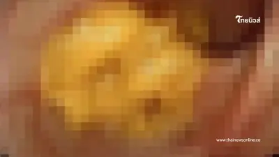 คนไข้คันตูด 3 วัน ปวดท้องเป็นพักๆ ส่องกล้องเจอสาเหตุ เล่นเอาขนลุก