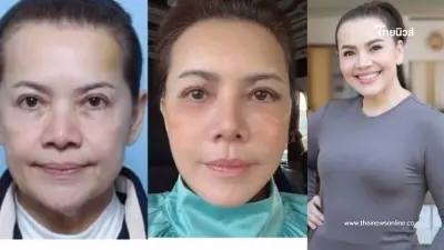 ส่องภาพล่าสุด "หนูแหม่ม สุริวิภา" ศัลยกรรมครบ 20 วัน สวยเป๊ะ หน้าเด็กเว่อร์