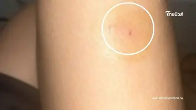 สาวถูกงูเห่ากัด ตอนตี 5 ล้างแผลทาเบตาดีน ไปทำงานต่อ สุดท้ายถูกหามเข้า ICU สาวถูกงูเห่ากัด ตอนตี 5 ล้างแผลทาเบตาดีน ไปทำงานต่อ สุดท้ายถูกหามเข้า ICU