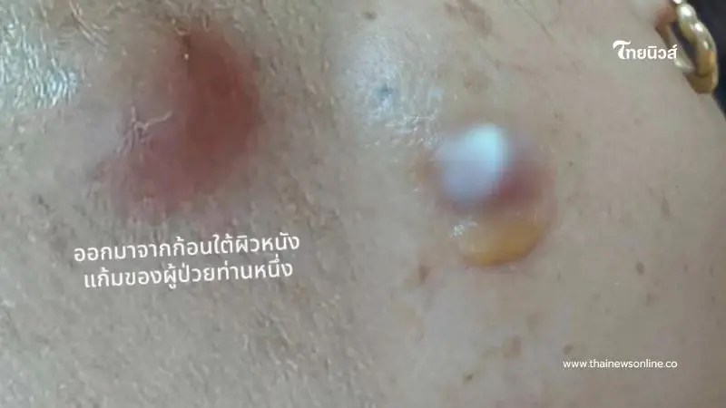 สาวคันรอบดวงตา เจอก้อนเนื้อขยับได้ หาหมอถึงกับตกใจรู้เป็นอะไร
