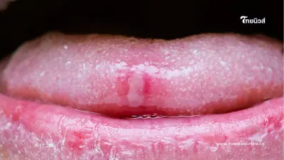 อาการร้อนใน เป็นแผลในปาก มีข้อควรรู้และวิธีรักษาให้หายไวขึ้น