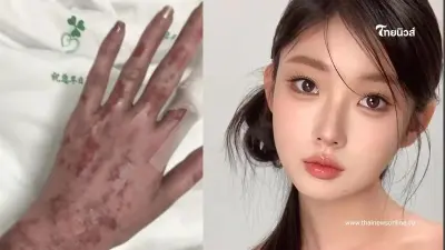 FC ตกใจ เห็นสภาพนางแบบสาววัย 27 ปี หลังโดนไฟคลอกทั่วร่าง