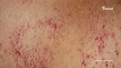 เตือน "ไข้เลือดออก" ระบาด หมอดังเปิด 10 ข้อร้ายแรง ที่ต้องรู้