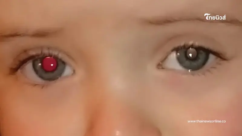เห็นตาขาวในภาพถ่ายลูก อย่าชะล่าใจ! นี่คือสัญญาณเตือนของมะเร็งจอตา