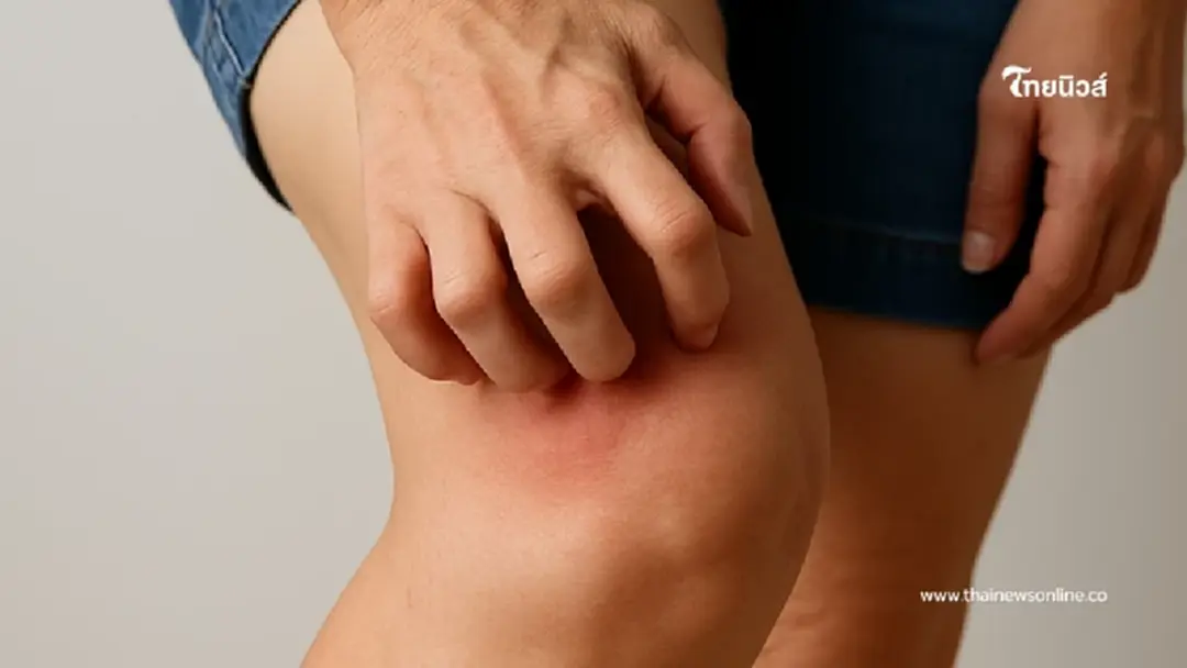 หญิงวัย 50 คันขารุนแรงไม่ทราบสาเหตุ สุดท้ายหมอบอกป่วยมะเร็ง